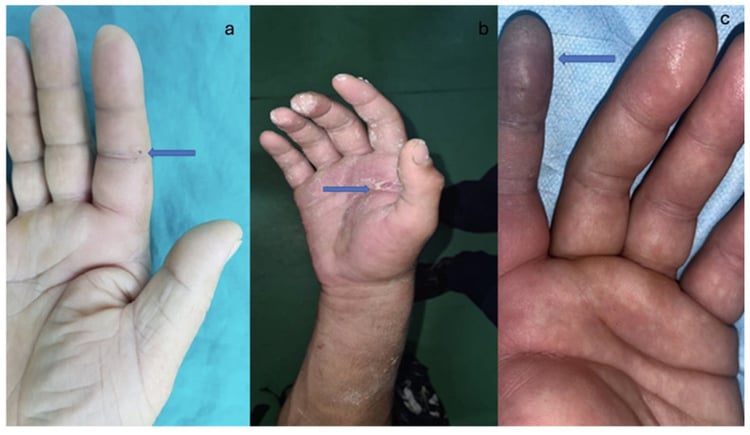 Pressure Injection Wound High-Pressure Injection Injury of the Hand | OrthoVellum