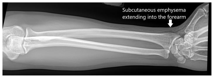 Forearm radiograph showing subcutaneous emphysema extending from high-pressure injection injury.