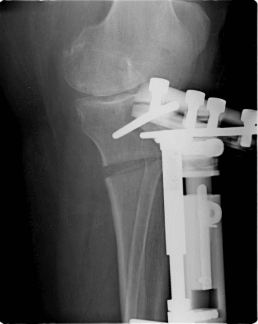 AP radiograph of a proximal tibial osteotomy held with a lateral external fixator, a high tibial osteotomy performed by the hemicallotasis technique.