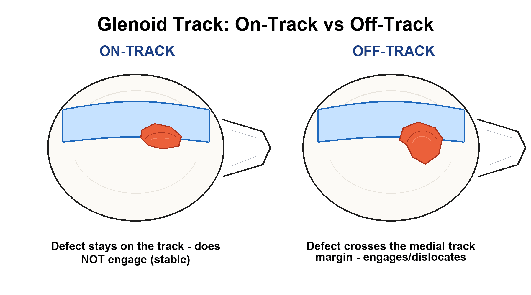 Schematic of the glenoid-track concept showing an on-track Hill-Sachs lesion contained within the track and an off-track lesion crossing the medial track margin.