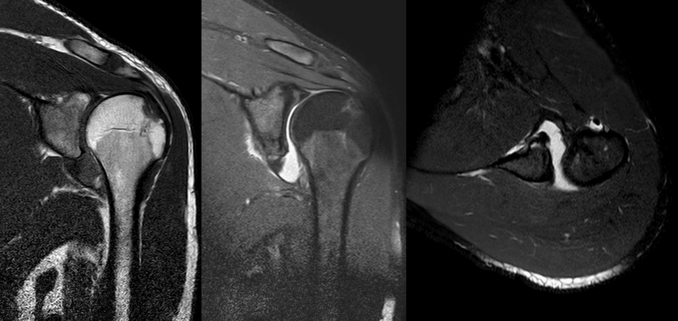 Shoulder MRI after anterior dislocation showing a posterolateral humeral head Hill-Sachs defect and an anterior labral Bankart lesion.
