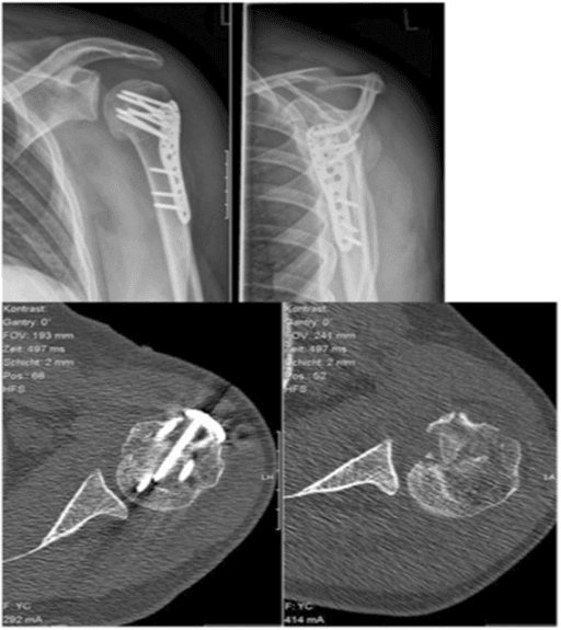Postoperative shoulder radiographs and axial CT after elevation and fixation of a large reverse Hill-Sachs defect.