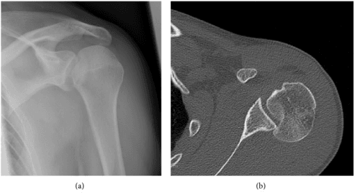 Radiograph and axial CT of a locked posterior shoulder dislocation with an anteromedial reverse Hill-Sachs defect.