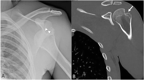 AP radiograph and coronal CT of an anterior shoulder dislocation with posterolateral humeral-head impaction.
