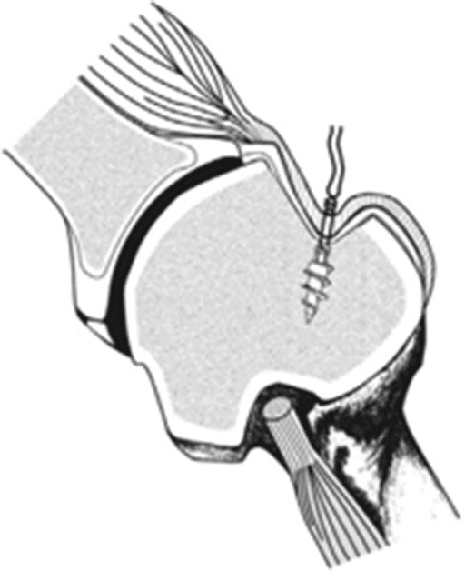 Schematic of arthroscopic remplissage with suture anchors securing posterior capsule and infraspinatus into the Hill-Sachs defect.
