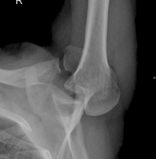 Axillary radiograph showing a locked posterior dislocation of the right shoulder.