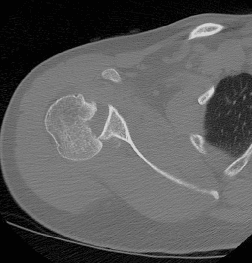 Axial CT showing a large anteromedial humeral-head defect in a locked posterior shoulder dislocation.