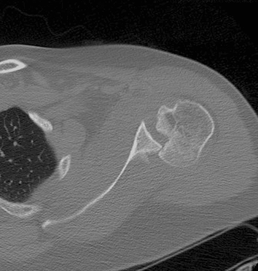 Axial CT showing an anteromedial humeral-head impaction defect in a left posterior shoulder dislocation.