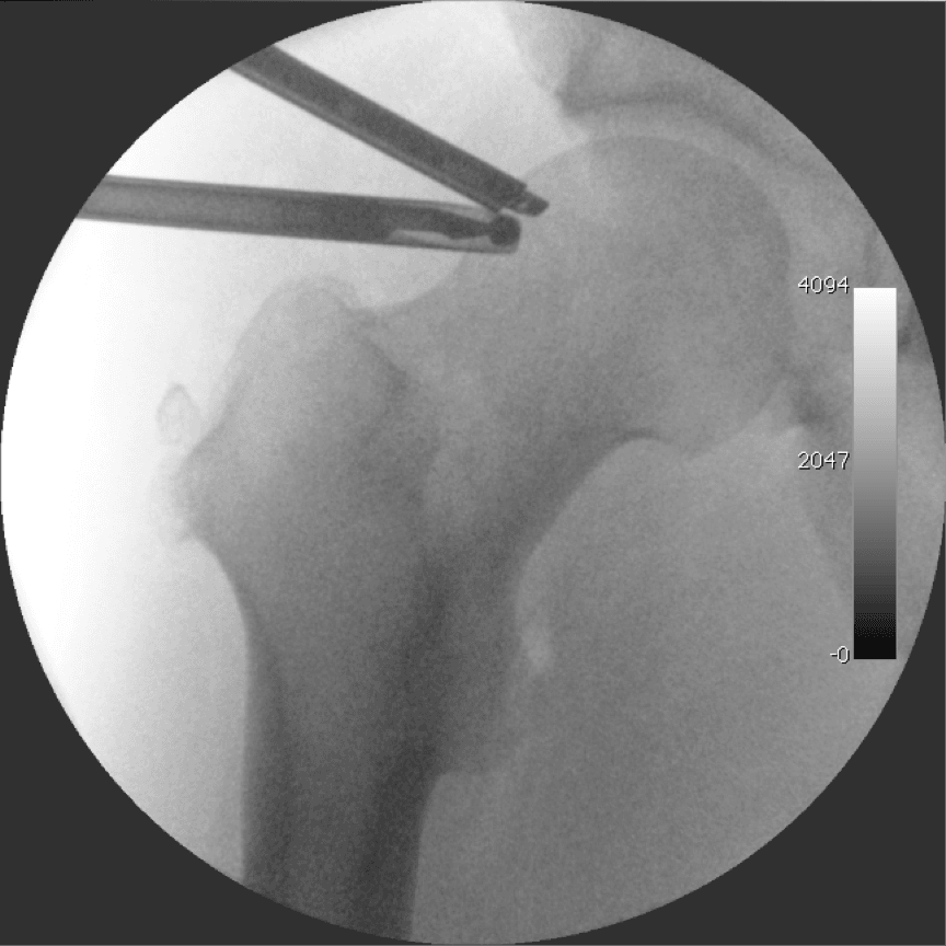Intra-operative fluoroscopy of the hip during arthroscopic resection of a femoral cam lesion, with an arthroscope and burr at the head-neck junction.