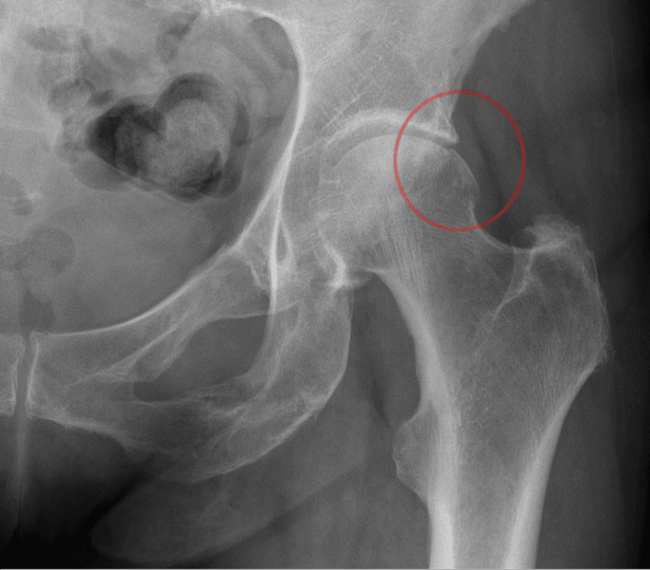 AP hip radiograph with a cam deformity circled at the femoral head-neck junction in femoroacetabular impingement.