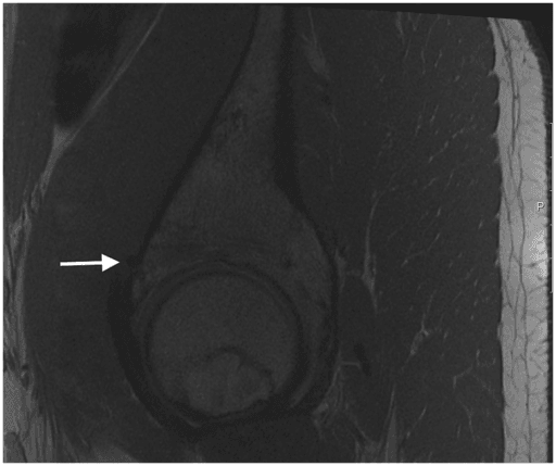 Sagittal MRI showing medial cortical perforation and a prominent suture anchor after hip arthroscopy.