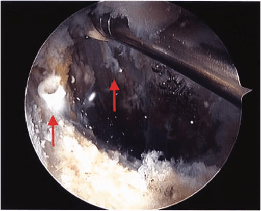 Arthroscopic view showing free-floating suture anchors within the psoas after hip arthroscopy.