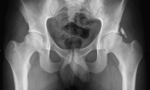 Follow-up AP pelvis showing heterotopic ossification after bilateral hip arthroscopy.