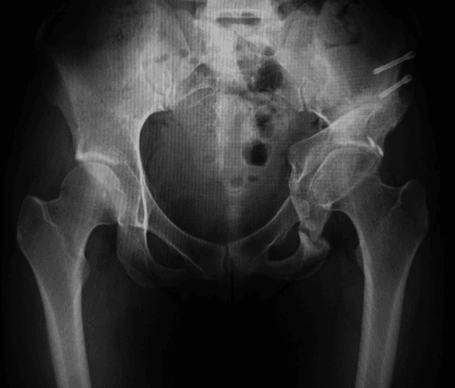 Postoperative AP pelvis after periacetabular osteotomy and labral repair showing improved acetabular coverage.