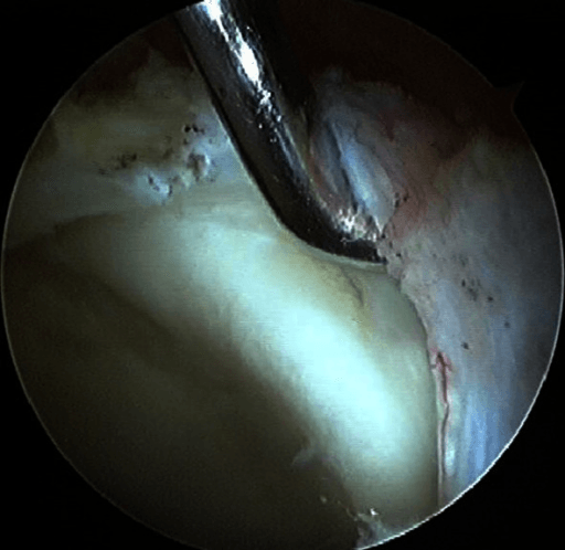 Arthroscopic view of an anterosuperior acetabular labral tear with intact-appearing cartilage.