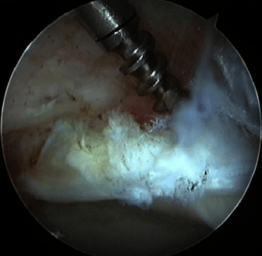 Arthroscopic labral repair with suture anchors and femoral-head osteochondroplasty.
