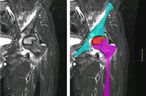 Coronal hip MRI showing osteonecrosis of the femoral head with the necrotic segment highlighted.