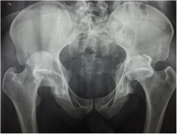 AP pelvic radiograph showing bilateral posterior hip dislocation with a right Pipkin type II femoral-head fracture.