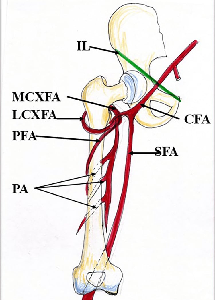 Schematic of the profunda femoris, medial and lateral circumflex femoral arteries and perforators around the proximal femur.