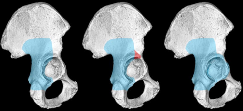 Three-panel three-dimensional comparison of Kocher-Langenbeck, modified Gibson and Ganz posterior acetabular exposures.