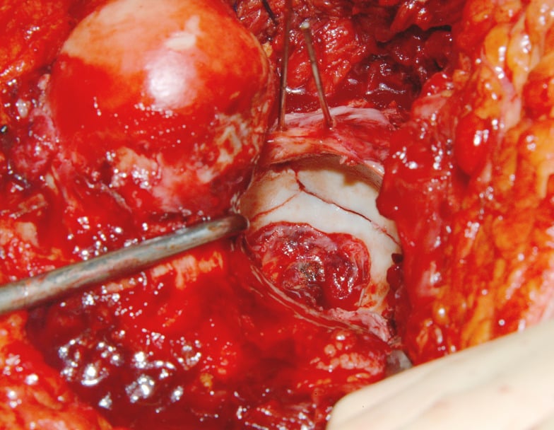Intraoperative exposure of the acetabulum and femoral head during Ganz surgical hip dislocation.