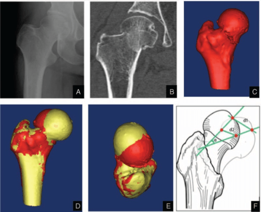 Garden stage I femoral neck fracture shown on radiograph, CT and three-dimensional reconstructions.