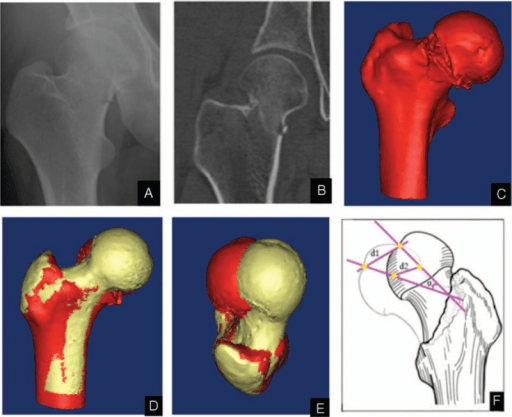Garden stage II femoral neck fracture shown on radiograph, CT and three-dimensional reconstructions.