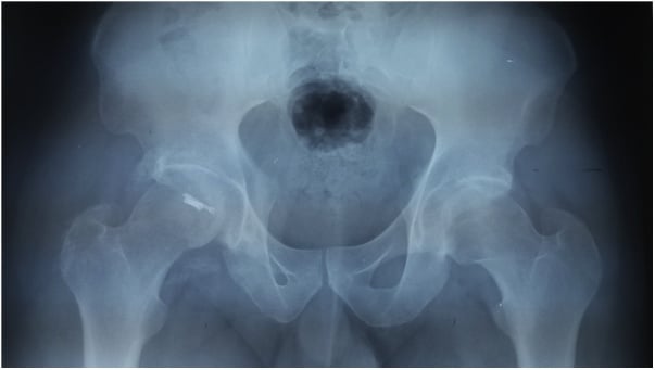 Two-year AP pelvic radiograph after femoral-head fracture fixation showing maintained reduction without radiographic avascular necrosis.