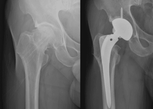 Radiograph pair showing femoral-head osteonecrosis after femoral-neck fixation and the subsequent total hip replacement.