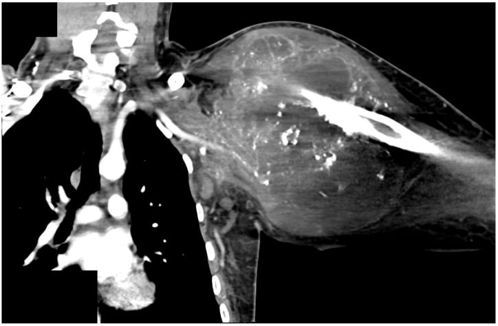 Coronal CT showing a large proximal humeral osteosarcoma extending into the glenohumeral joint, rotator cuff and chest-wall musculature.