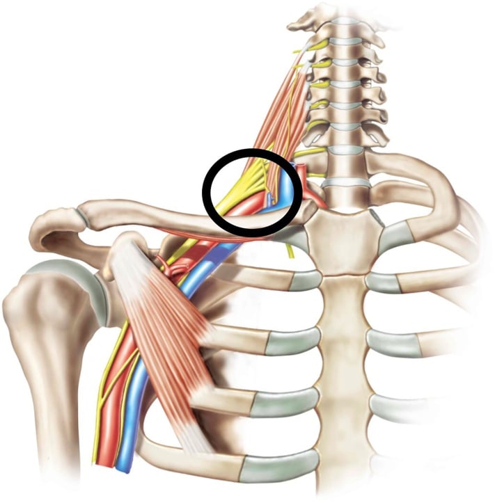 Anterior shoulder-girdle diagram showing the medial, lateral and posterior cords of the brachial plexus around the axillary artery.