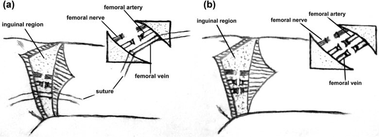 Diagrams comparing simultaneous femoral artery-and-vein ligation with artery-first delayed femoral-vein ligation during hip disarticulation.