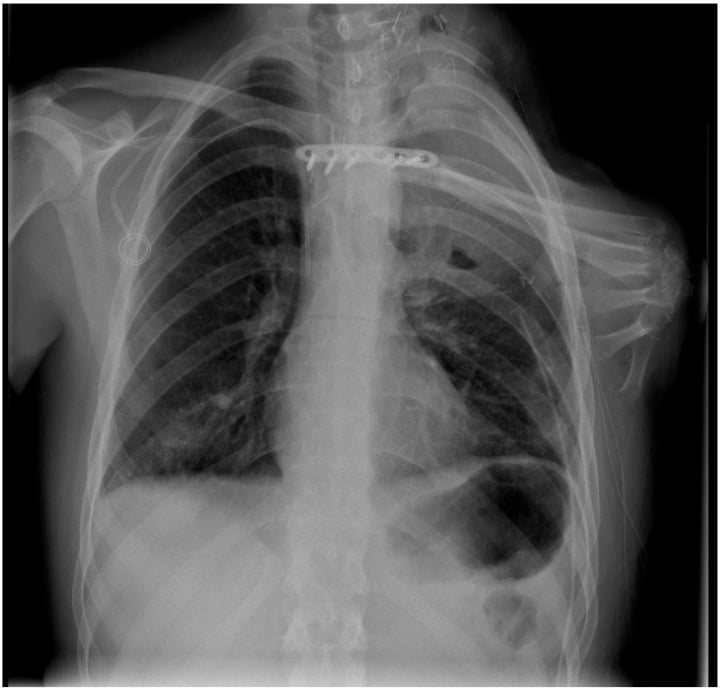 Postoperative chest radiograph after forequarter amputation and osteomusculocutaneous free fillet-flap reconstruction using the tumour-free forearm for shoulder contour.