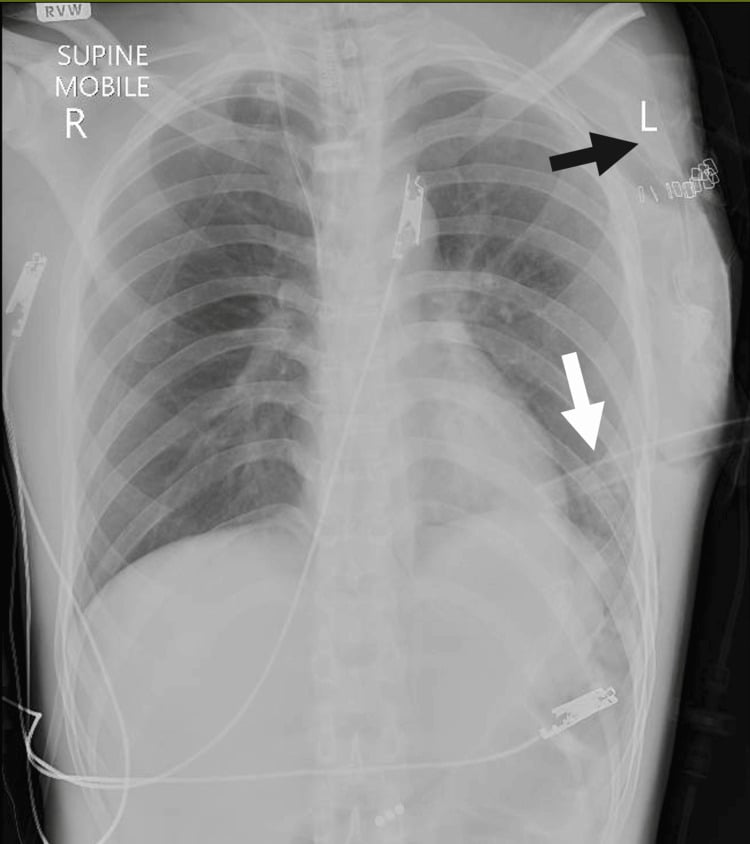 Immediate postoperative chest radiograph after forequarter amputation showing the intercostal drain and surgical staples.