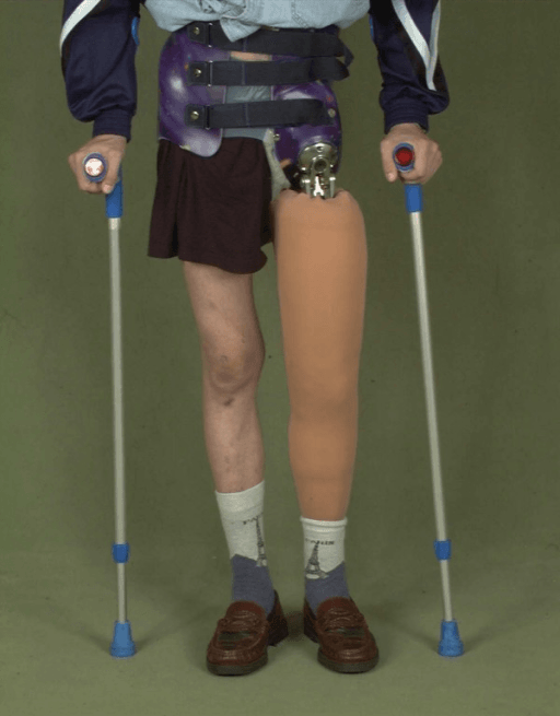 Custom prosthetic limb made for a patient after hip disarticulation.