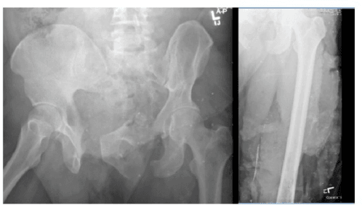 Pelvic radiographs showing a massive open APC type 3 pelvic-ring injury and the remaining proximal femur after above-knee amputation.