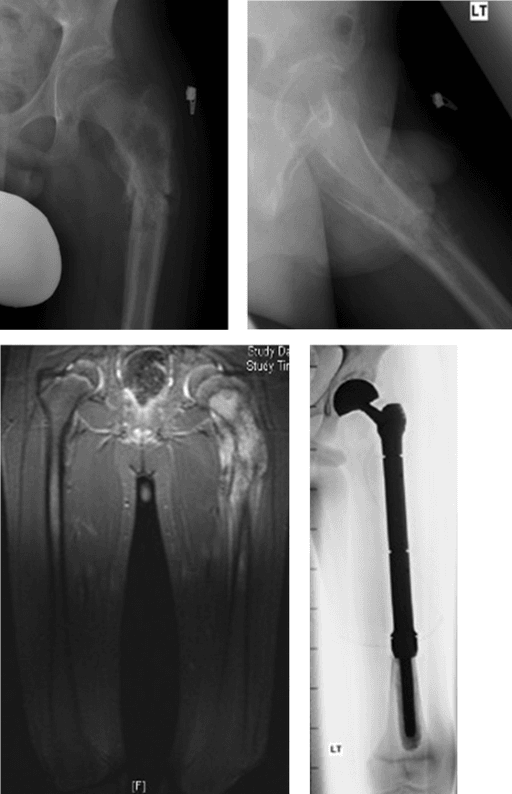 Radiographs and MRI of proximal femoral osteosarcoma alongside a postoperative radiograph of a proximal femoral endoprosthesis.