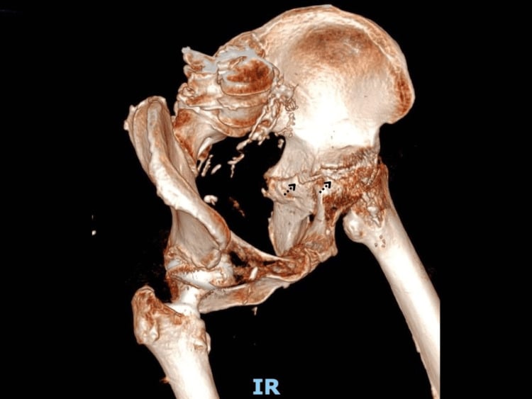 3D CT reconstruction demonstrating posterior hip dislocation and acetabular wall bone loss