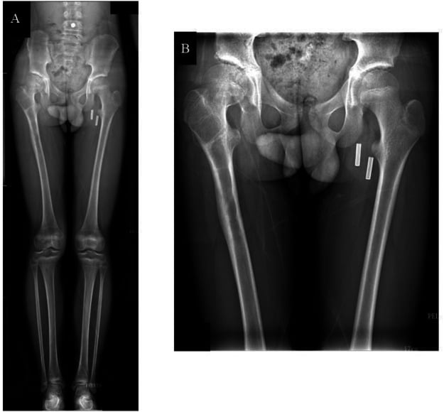 Pelvic radiograph demonstrating post-traumatic femoral head avascular necrosis