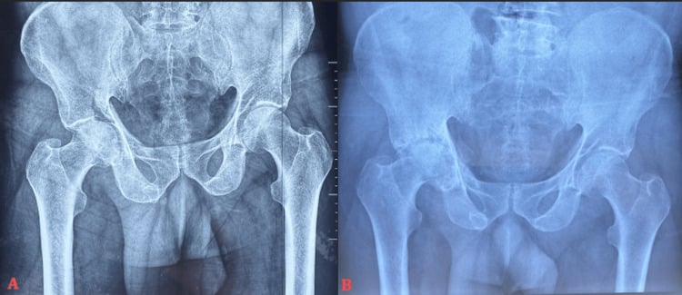Pelvic radiographs showing progression to femoral head avascular necrosis
