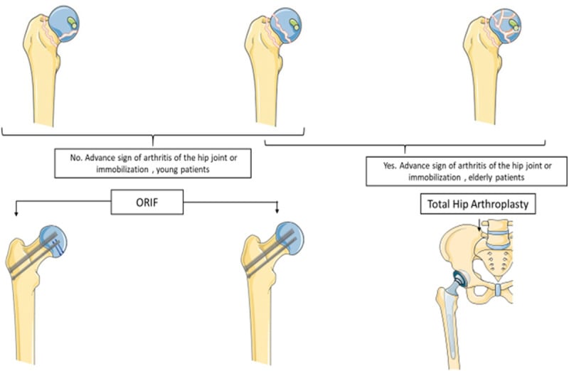 Flowchart diagram illustrating surgical decision-making for Pipkin femoral head fractures