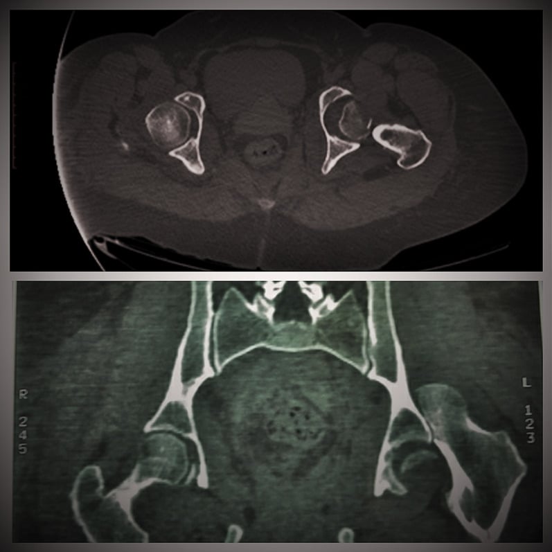 Axial and coronal CT scans showing femoral head fracture in hip dislocation
