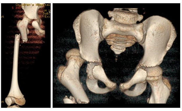 3D CT reconstruction showing femoral shaft fracture with posterior hip dislocation
