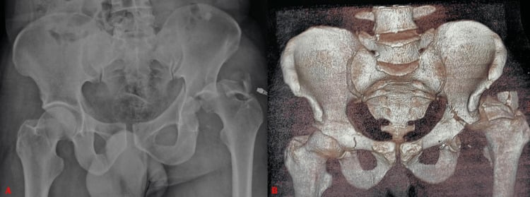 AP pelvic radiograph and 3D CT showing transverse acetabular fracture-dislocation