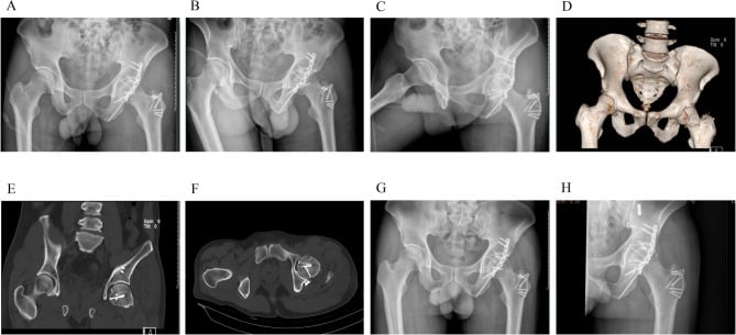 Radiographs and 3D CT series demonstrating Pipkin femoral head fracture classification
