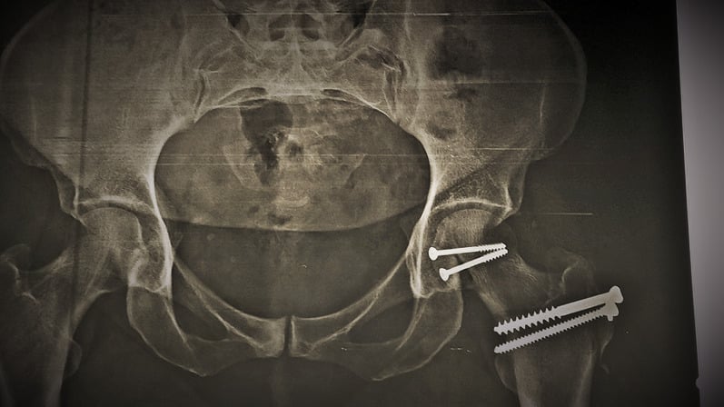 Postoperative pelvis radiograph showing screw ORIF of Pipkin femoral head fracture
