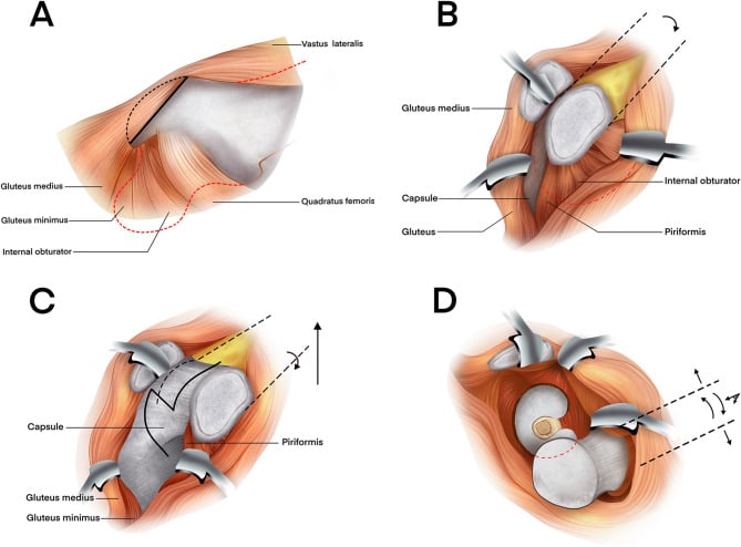 Anatomical diagrams of open reduction of femoral head fracture via trochanteric flip approach