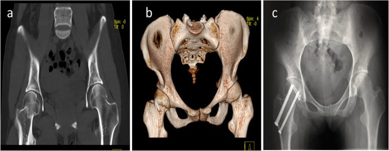 Coronal CT, 3D CT, and postoperative radiograph of Pipkin III fracture ORIF
