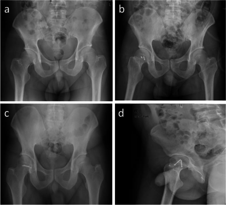 AP pelvic and lateral hip radiographs demonstrating anatomical closed reduction of Pipkin fracture