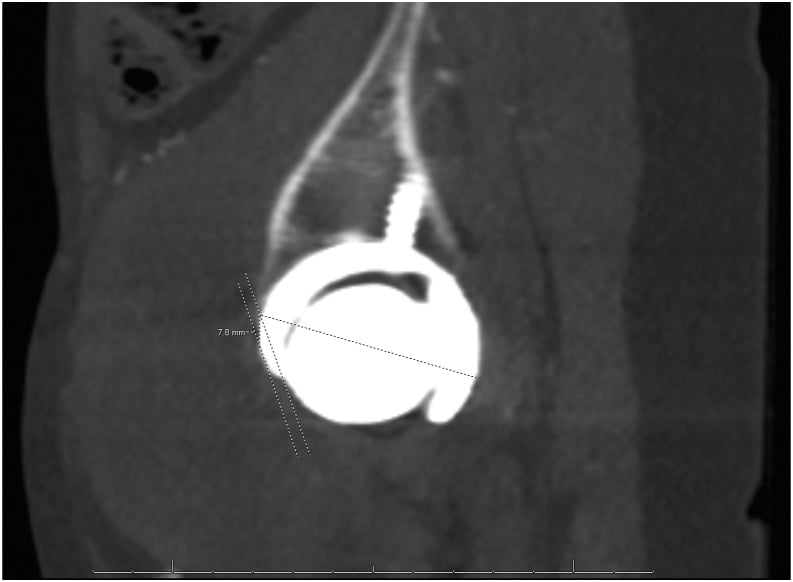 Sagittal CT after total hip arthroplasty showing 7.8 millimetres of anterior acetabular component overhang